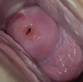 Age 21 - Post-Abortion Beautiful Cervix Project