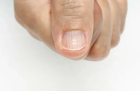 Tiny dents in fingernails Dents in Fingernails