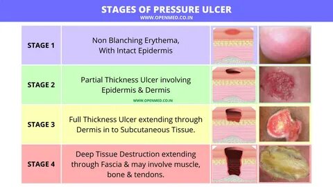 bed sores stages pictures - imacomcampus.com.