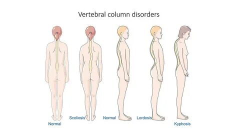 File:Vertebral column disorders - Normal Scoliosis Lordosis 