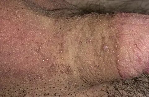Papilloma in Men Pictures - 111 Photos & Images / illnessee.