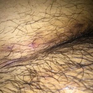 Inflamed Ingrown Pubic Hair - Ingrown Pubic Hair Treatment A