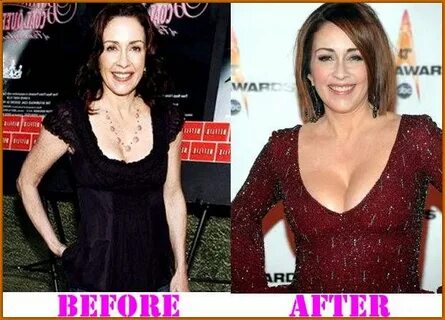 The Impact Of Patricia Heaton Plastic Surgery Patricia Heato