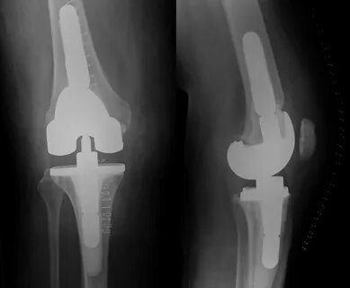 Knee Replacement - Sussex Knee Surgery
