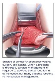What is a vaginal fissure ðŸŒˆ Perineum Skin Hanging : The peri