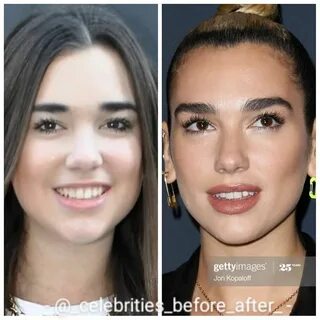 ★ Celebrity Plastics ★ on Instagram: "🤫 Before/After: @dualipa. Follow @celebrit