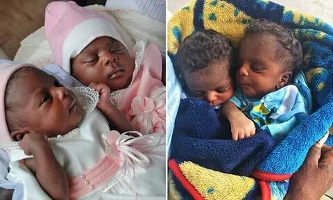Conjoined Congo twins have surgery to separate