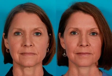 Facial Fat Transfer before and after patient photos