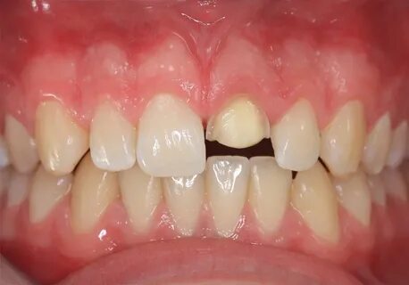 Zahnrekonstruktion Zahnarztpraxis Dr. Lohmann