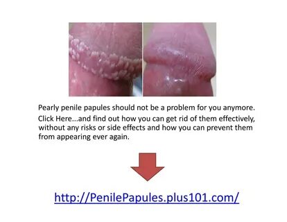 PPT - Pearly Whites, Anaesthetic Cream For Ppp, Pearly Penil