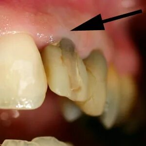 Dental crown Dentalnews (en)