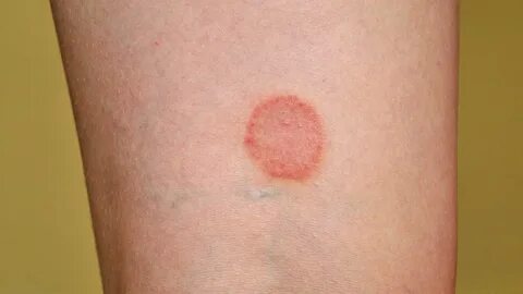 Is That Rash Psoriasis? Psoriasis Pictures and More Everyday