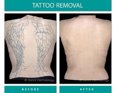 Yellow Skin After Tattoo Removal - Alliance Pacific