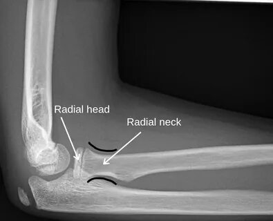 Radial head and neck fractures - Don't Forget the Bubbles