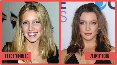 Katie Cassidy Plastic Surgery Before After Plastic surgery, 