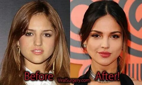 Eiza Gonzalez plastic surgery sure not just a rumor. She adm