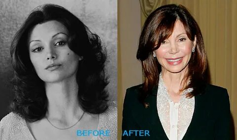 Victoria Principal Plastic Surgery Before and After
