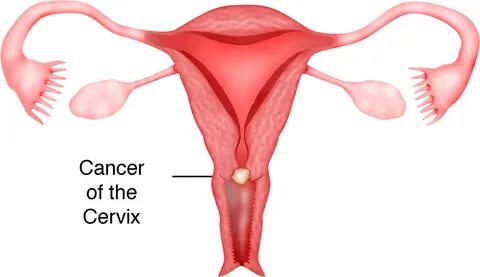 Chapter 13 - Cancer of the Cervix - Melaka Fertility