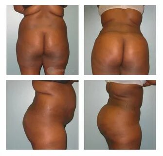 Brazilian Butt Lift Before and After in Columbus Ohio