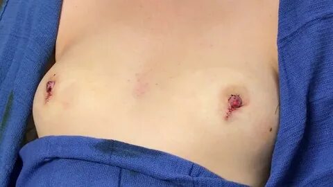 Nipple Surgery for Inverted Nipple - YouTube