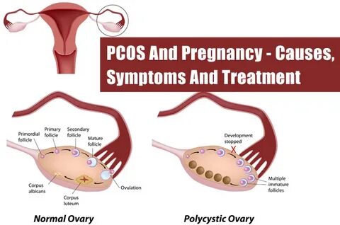 Polycystic Ovary Syndrome And Pregnancy Test - Captions More