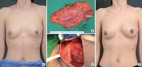 How boobs look after implant removal