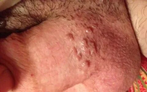 Bump on Testicles, Small, Hard, White, Red Bumps on Scrotum 
