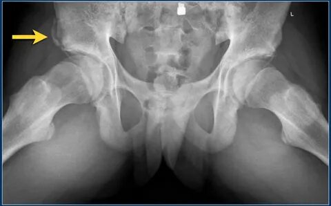The Radiology Assistant : Hip pathology in Children