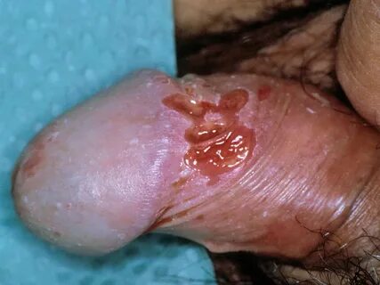 Herpes genitalis (genitale herpes, herpes simplex genitalis)