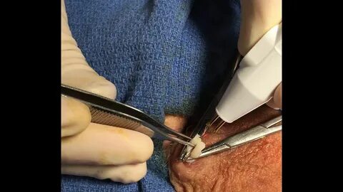 Northeast Georgia Urological Associates-A vasectomy through 