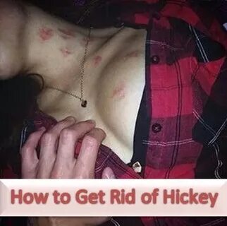 How to Get Rid of Hickies Fast