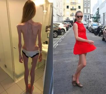 Anorexic Girl Inspires People To Get Healthy After Being Day