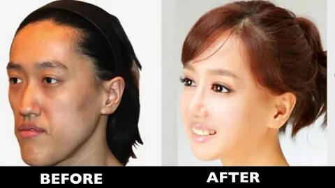 15 Korean Plastic Surgery Before & After Photos - YouTube