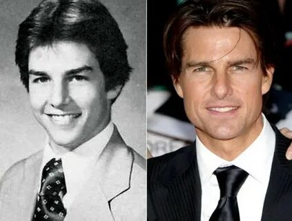 Tom Cruise before and after plastic surgery 05 Celebrity pla