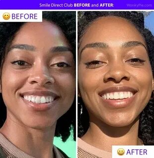 45 Smile Direct Club Transformations (Before & After!) Smile