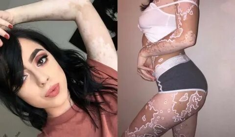 Woman with vitiligo turns her skin condition into a work of 