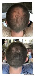 3 months or Minoxidil/Finasteride progress as of today! #hai