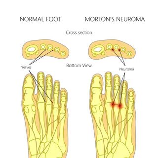Morton’s Neuroma - The Back and Body Clinic Specialist Physi