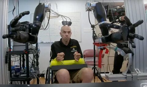 One Brain, Two Bionic Arms. This man is learning to move two