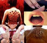 Images of Enlarged Pores Trypophobia - #golfclub