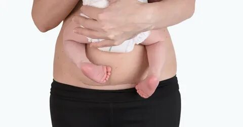 Kaiserschnittnarbe: Behandlung, Heilung und Tipps