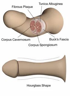 Peyronie's Disease