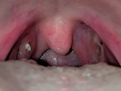 Are Small Tonsil Stones Normal