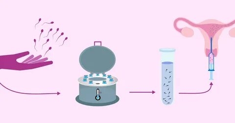 CORION FERTILITY CLINIC: What & How of IUI-Intra-Uterine Ins