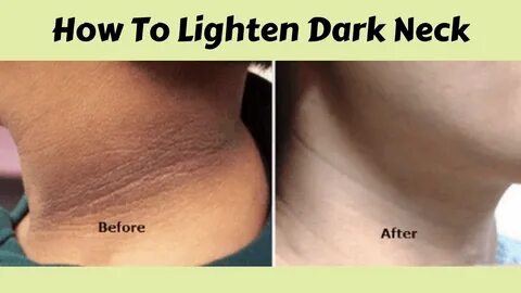 How To Get Rid Of Dark Neck Naturally(Quick And Easy Way) - 