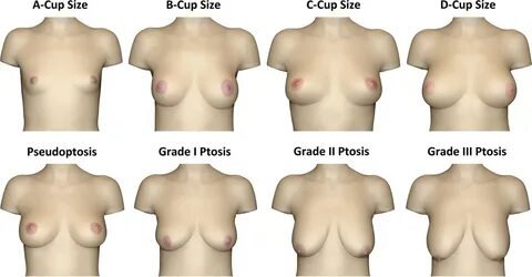 Analysis of the Visual Perception of Female Breast Aesthetic