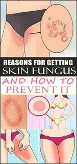 Reasons for getting skin fungus and how to prevent it we’ve all encountered...