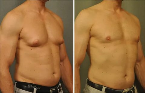 Gynecomastia is a medical condition which describes an excess accumulation ...