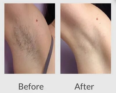 Laser Hair Removal - The Derm Dermatologists in Cook County,