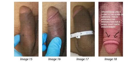 Circumcision and Circumcision Corrective Surgery - Loria Med